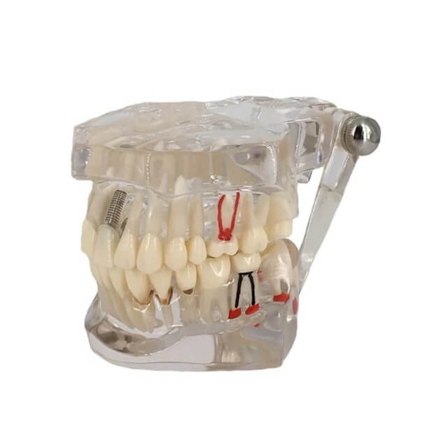 Модель зубного імплантату для стоматолога