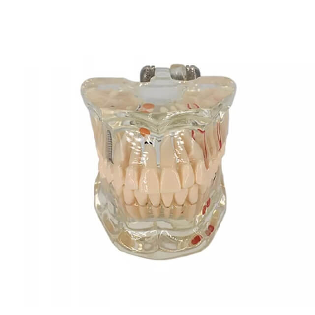 Прозора патологічна модель зубів