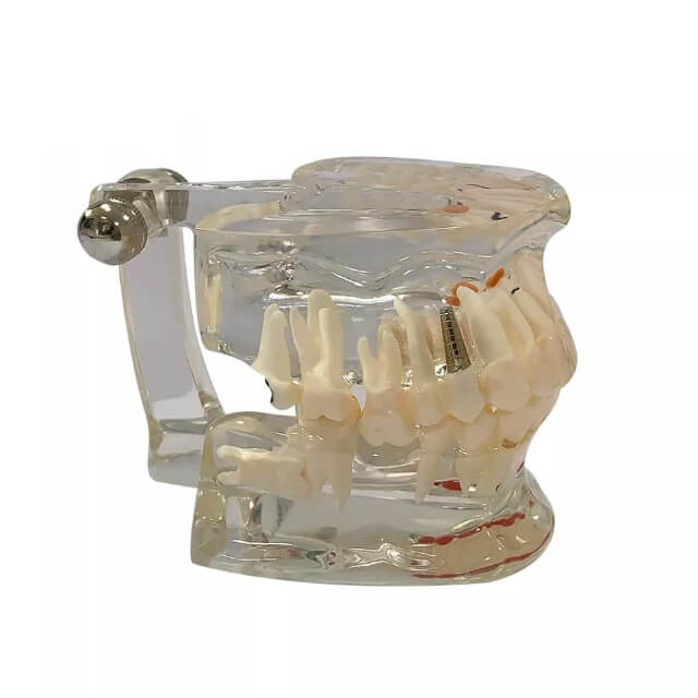 Прозора патологічна модель зубів