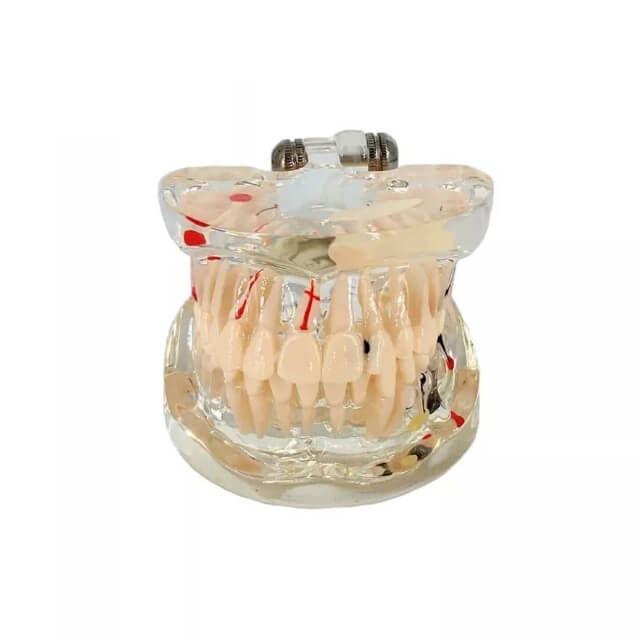Прозора модель імплантату зуба