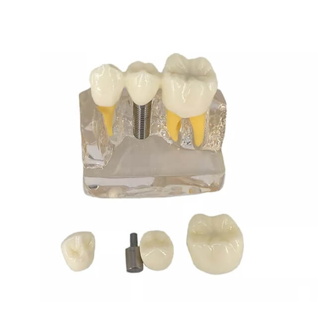Стоматологічна модель імплантату зуба