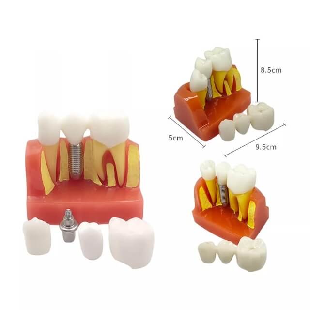 Модель імплантату зуба для вивчення