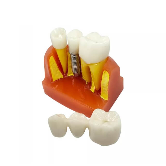 Модель імплантату зуба для вивчення